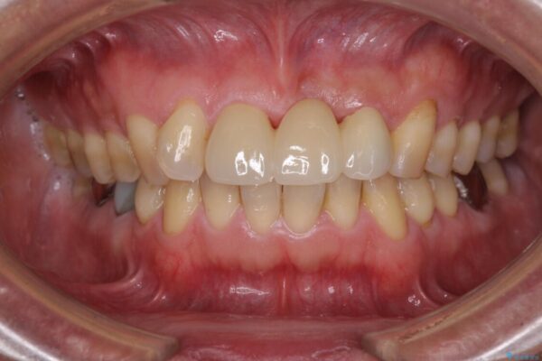 不自然な前歯のブリッジをオールセラミックできれいに 治療後画像