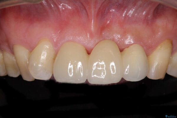 不自然な前歯のブリッジをオールセラミックできれいに 治療後画像