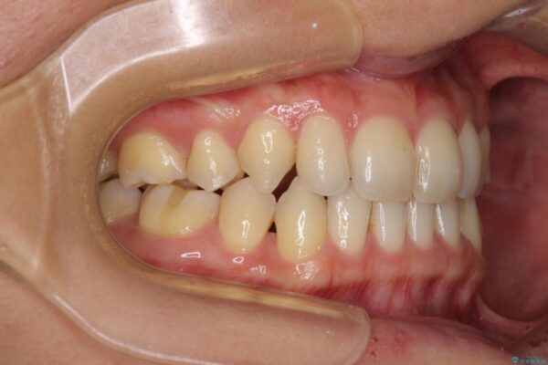 抜歯矯正の後戻りによるすきっ歯をインビザラインで治療 治療後画像