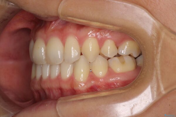 抜歯矯正の後戻りによるすきっ歯をインビザラインで治療 治療後画像