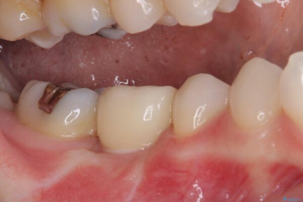 折れてしまった下の奥歯のインプラント治療 治療後画像