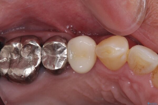 折れてしまった奥歯　インプラントによる補綴治療 治療後画像