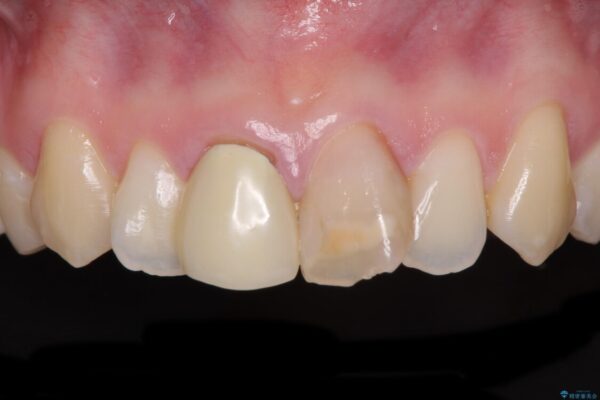 変色した前歯のオールセラミック治療 治療前画像