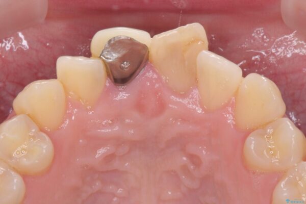変色した前歯のオールセラミック治療 治療前画像