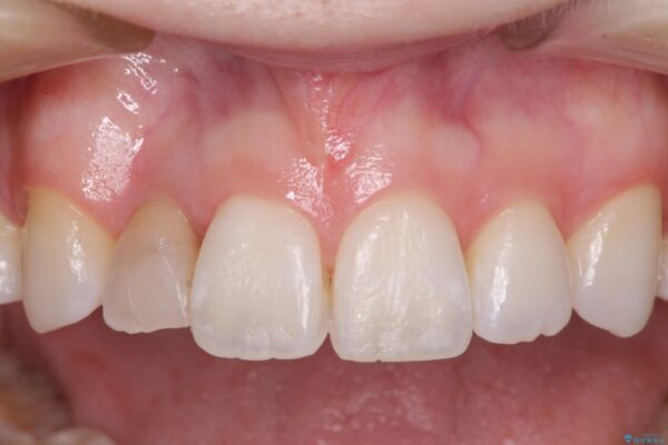 変色した前歯　オーダーメイドタイプのオールセラミッククラウン 治療前画像