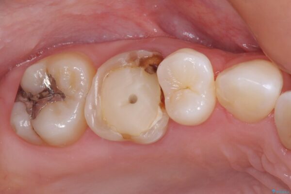 変色した前歯　オーダーメイドタイプのオールセラミッククラウン 治療前画像