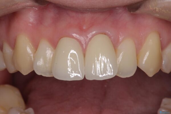 変色した前歯のオールセラミック治療 治療後画像