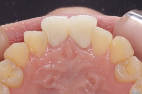 変色した前歯のオールセラミック治療 治療後画像