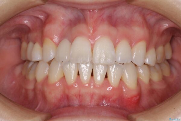 変色した前歯　オーダーメイドタイプのオールセラミッククラウン 治療後画像