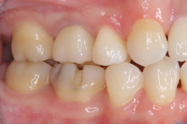 変色した前歯　オーダーメイドタイプのオールセラミッククラウン 治療後画像