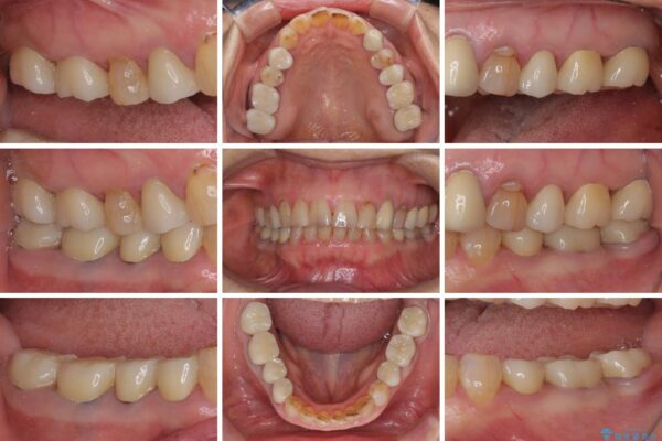 全ての奥歯の銀歯をセラミックに　メタルフリー治療 治療後画像