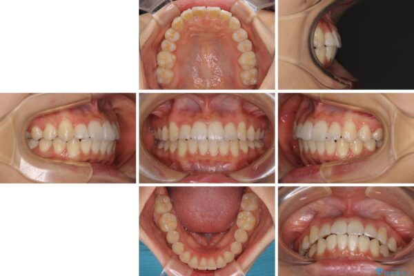 短期間で楽に治療を進めたい　ワイヤー装置での非抜歯矯正 治療後画像