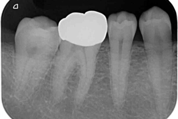 奥歯の銀歯が目立って気になる　奥歯のセラミッククラウン 治療前画像