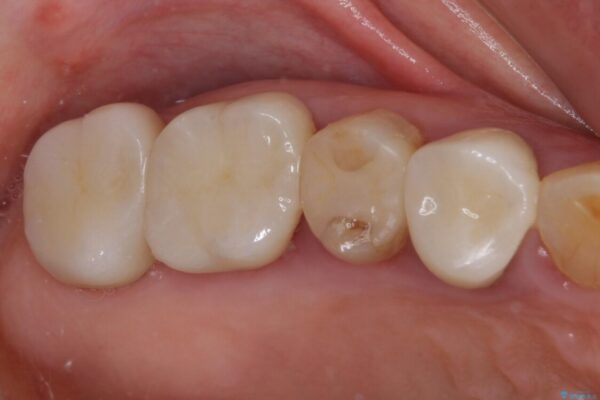 全ての奥歯の銀歯をセラミックに　メタルフリー治療 治療後画像