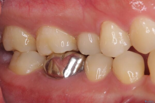 奥歯の銀歯が目立って気になる　奥歯のセラミッククラウン 治療前画像