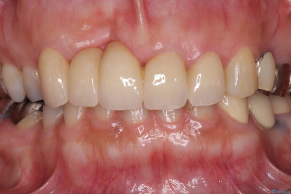 汚い仮歯で困っている　前歯のオールセラミックブリッジ 治療後画像