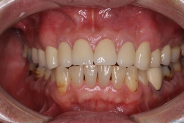統一感のない前歯を綺麗にしたい　オールセラミッククラウンによる治療 治療後画像