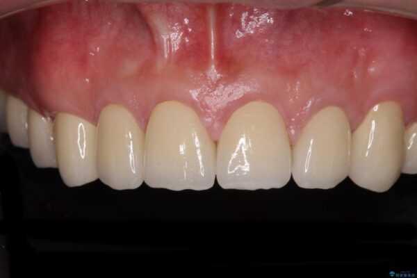 統一感のない前歯を綺麗にしたい　オールセラミッククラウンによる治療 アフター