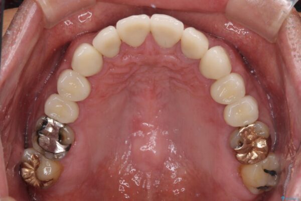 統一感のない前歯を綺麗にしたい　オールセラミッククラウンによる治療 治療後画像