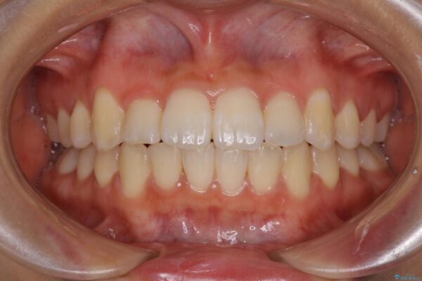 短期間で楽に治療を進めたい　ワイヤー装置での非抜歯矯正 治療後画像