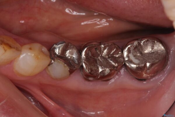 全ての奥歯の銀歯をセラミックに　メタルフリー治療 治療前画像