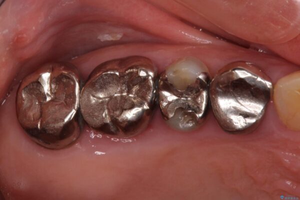 全ての奥歯の銀歯をセラミックに　メタルフリー治療 治療前画像