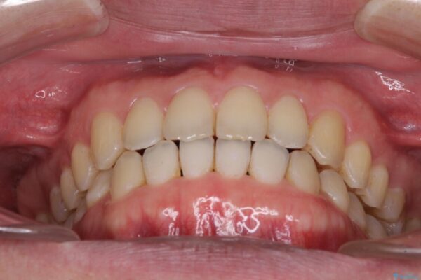 前歯すきっ歯の改善　インビザライン矯正治療 治療後画像