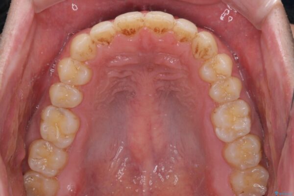 前歯すきっ歯の改善　インビザライン矯正治療 治療後画像