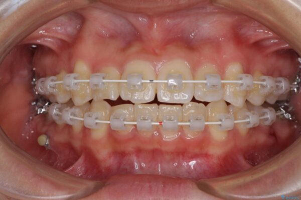 短期間で楽に治療を進めたい　ワイヤー装置での非抜歯矯正 治療途中画像