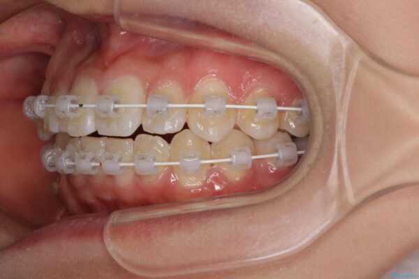 短期間で楽に治療を進めたい　ワイヤー装置での非抜歯矯正 治療途中画像