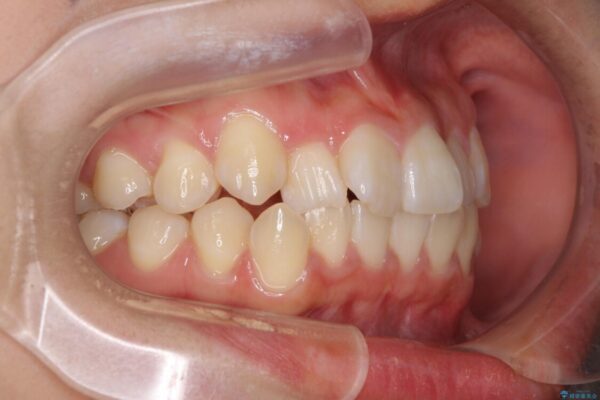 短期間で楽に治療を進めたい　ワイヤー装置での非抜歯矯正 治療前画像