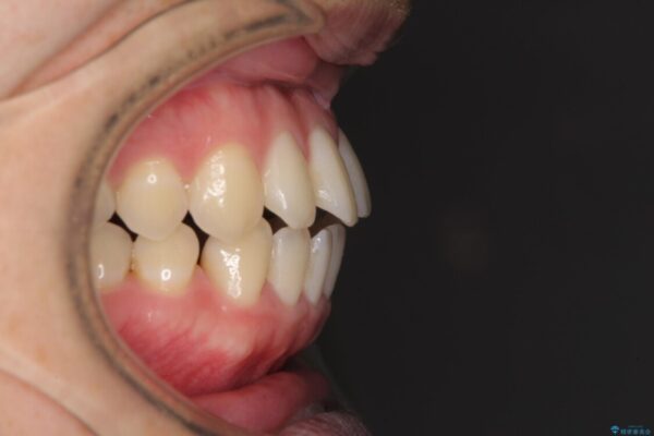 前歯すきっ歯の改善　インビザライン矯正治療 治療前画像