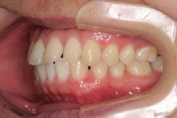 前歯すきっ歯の改善　インビザライン矯正治療 治療前画像