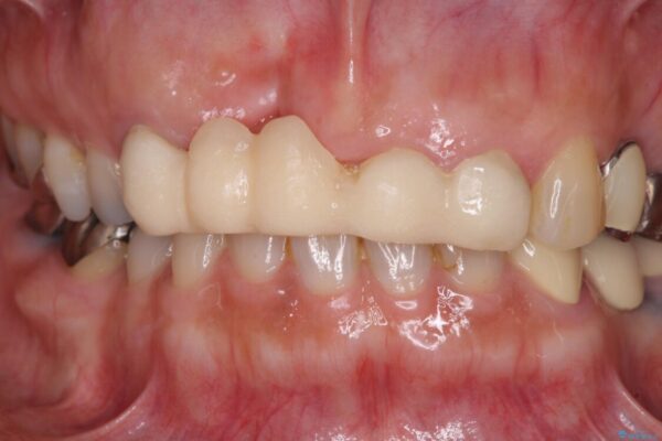 汚い仮歯で困っている　前歯のオールセラミックブリッジ 治療前画像