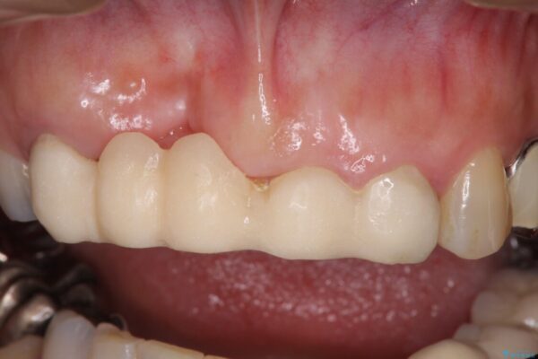 汚い仮歯で困っている　前歯のオールセラミックブリッジ 治療前画像