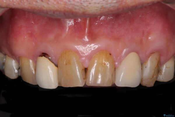 統一感のない前歯を綺麗にしたい　オールセラミッククラウンによる治療 ビフォー