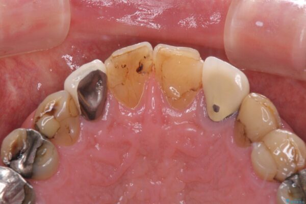 統一感のない前歯を綺麗にしたい　オールセラミッククラウンによる治療 治療前画像