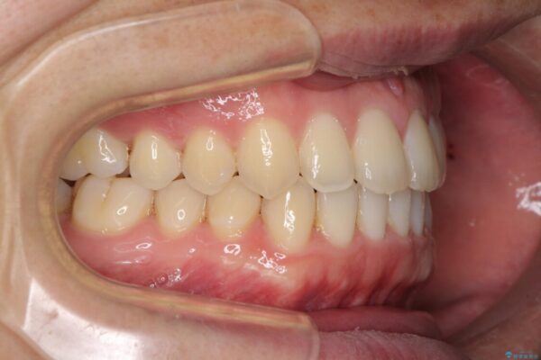 前歯すきっ歯の改善　インビザライン矯正治療 治療途中画像