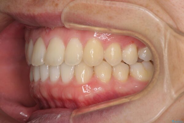 前歯すきっ歯の改善　インビザライン矯正治療 治療途中画像