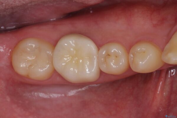 奥歯の銀歯が目立って気になる　奥歯のセラミッククラウン 治療後画像