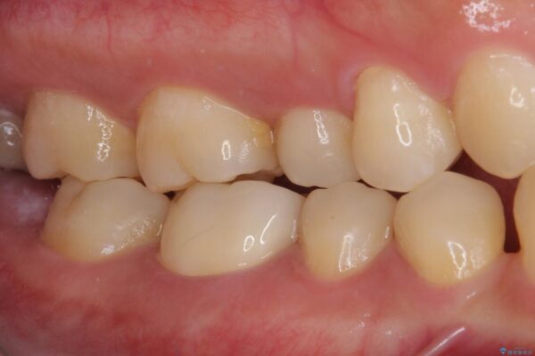 奥歯の銀歯が目立って気になる　奥歯のセラミッククラウン 治療後画像