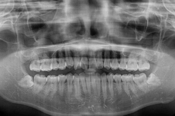 短期間で楽に治療を進めたい　ワイヤー装置での非抜歯矯正 治療前画像