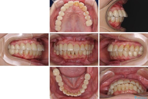 歯周病改善のための総合歯科治療 治療後画像