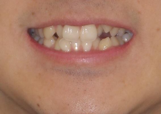 八重歯を治したい　目立たないワイヤー装置での抜歯矯正 治療前画像