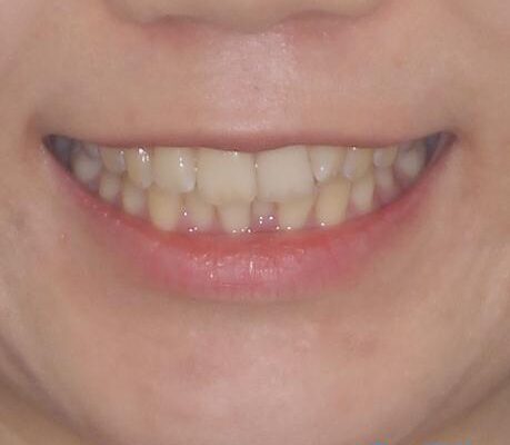 前歯のデコボコを解消　インビザラインによる矯正治療 治療前画像