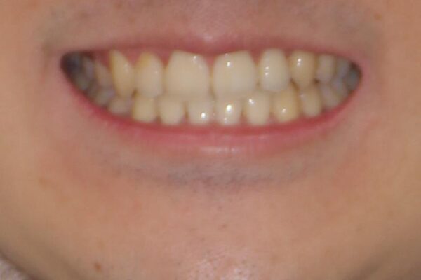八重歯を治したい　目立たないワイヤー装置での抜歯矯正 治療後画像