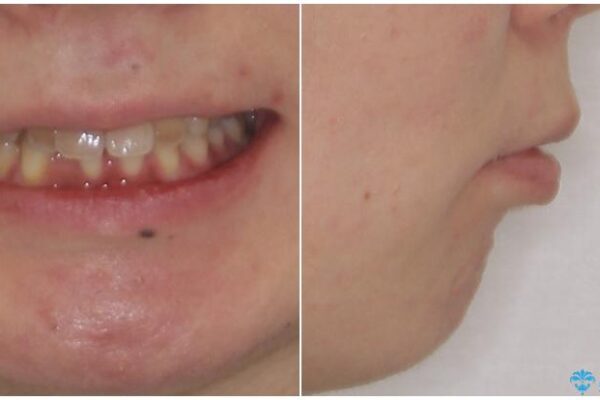閉じにくい口元　前歯を引っ込める抜歯矯正 治療前画像
