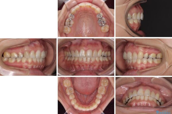 前歯の突出を軽減　インビザラインによる抜歯矯正 治療後画像