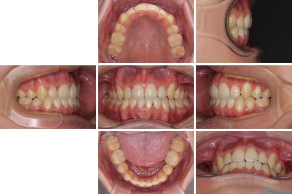 八重歯を治したい　目立たないワイヤー装置での抜歯矯正 治療後画像