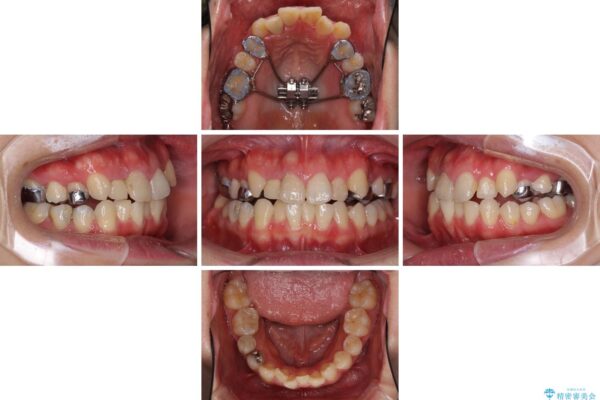 狭い上顎骨を拡大　インビザラインによる非抜歯矯正 治療途中画像